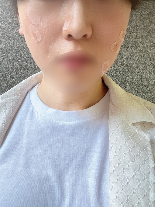 SENA（セナ） 今日はホクロの除去✨